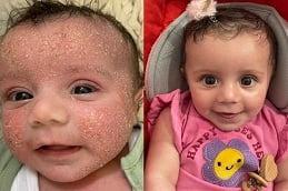 Results of Baby Skin Facial in Dubai