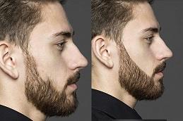 Results of Beard Micropigmentation before & Afte clinic Dubai