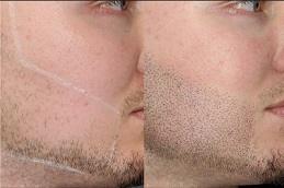 Results of Beard Micropigmentation before & After Dubai