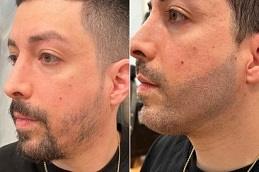 Results of Beard Micropigmentation clinic in Dubai