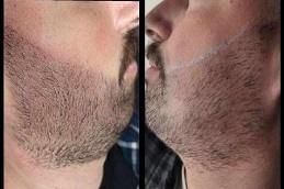 Results of Beard Micropigmentation in Dubai & Abu Dhabi