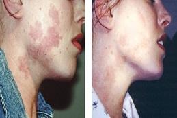 Results of Birthmarks Removal clinic Dubai & Abu Dhabi