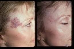 Results of Birthmarks Removal clinic Dubai