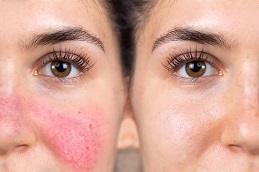 Results of Birthmarks Removal in Dubai