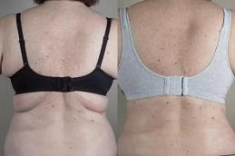 Results of Bra Lift Surgery clinic in Dubai & Abu Dhabi