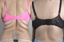Results of Bra Lift Surgery clinic in Dubai