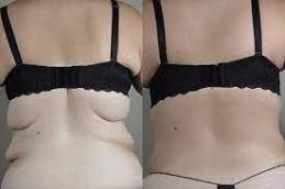 Results of Bra Lift Surgery in Dubai & Abu Dhabi