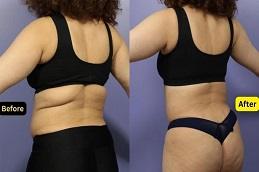 Results of Bra Lift Surgery in Dubai