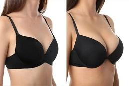 Results of Breast Lift Surgery Dubai