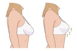 Results of Breast Lift Surgery before & After in Dubai