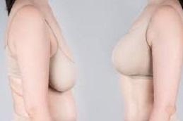 Results of Breast Lift Surgery clinic Dubai & Abu Dhabi