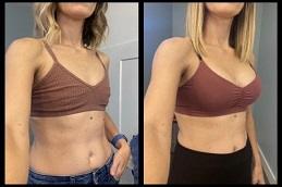 Results of Breast Reconstruction Dubai,