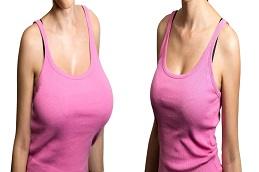 Results of Breast Reconstruction before & After Dubai