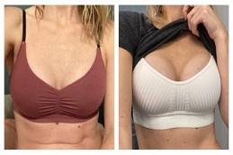 Results of Breast Reconstruction clinic in Dubai