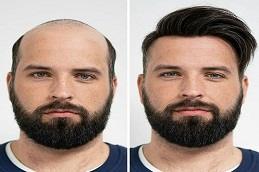 Results of Human Hair Wigs clinic in Dubai