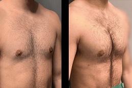 Results of Male Pectoral Implants Dubai
