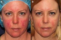 Results of Rosacea Treatment Dubai