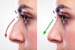 Rhinoplasty Before & After in Dubai & Abu Dhabi