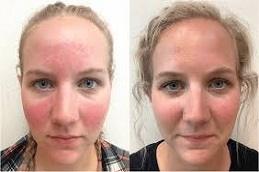 Rosacea Treatment before & After in Dubai