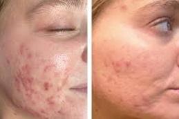 Salicylic Acid Peeling before & After Dubai & Abu Dhabi