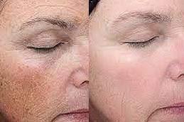 Salicylic Acid Peeling before & After in Dubai,