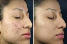 Salicylic Acid Peeling before & After in Dubai
