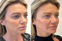 Skin Rejuvenation before & after Dubai