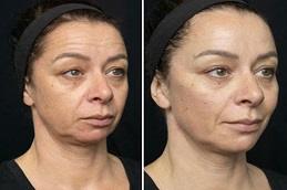 Skin Rejuvenation before & after Dubai