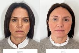 Skin Rejuvenation before & after clinic in Dubai