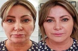 Skin Rejuvenation before & after clinic in Dubai