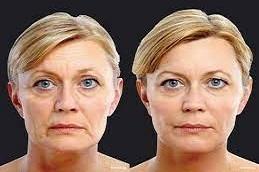 Skin Rejuvenation before & after in Dubai