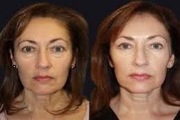 Skin Rejuvenation before & after