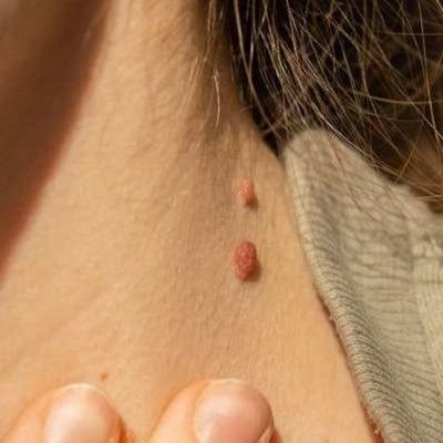 Skin Tag Removal in Dubai & Abu Dhabi