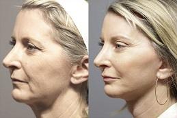 Sugar Thread Lift Treatment clinic in Dubai