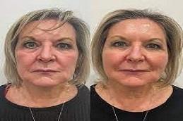 Sugar Thread Lift Treatment clinic in Dubai