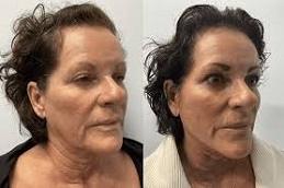 Sugar Thread Lift Treatment in Dubai