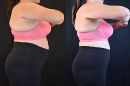 Tirzee Injections before & After clinic Dubai