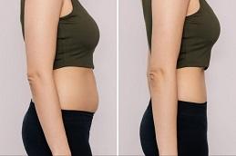 Tirzee Injections before & After in Dubai