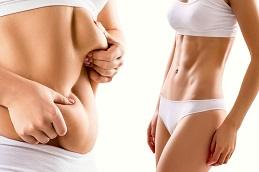 Tummy Tuck before & After in Dubai