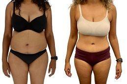 Tummy Tuck clinic in Dubai