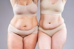 Tummy tuck before & After