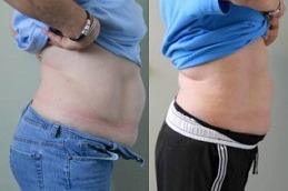 Vibro Liposuction before & After Dubai