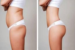Vibro Liposuction before & After clinic Dubai 