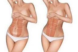 Vibro Liposuction before & After clinic Dubai