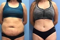 Vibro Liposuction before & After clinic Dubai