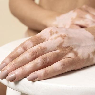 Vitiligo Treatment in Dubai & Abu Dhabi