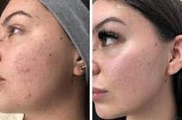 korean glass skin facial before and after Dubai
