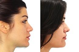 Alarplasty before & After clinic in Dubai