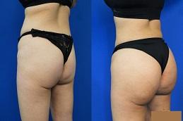 Buttock Lift before & After Dubai