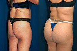 Buttock Lift before & After in Dubai
